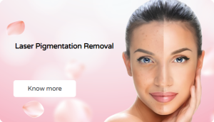 laser pigmentation removal